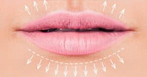 Scopri di più sull'articolo Preenchimento ou Botox Labial em Fortaleza: Qual escolher?