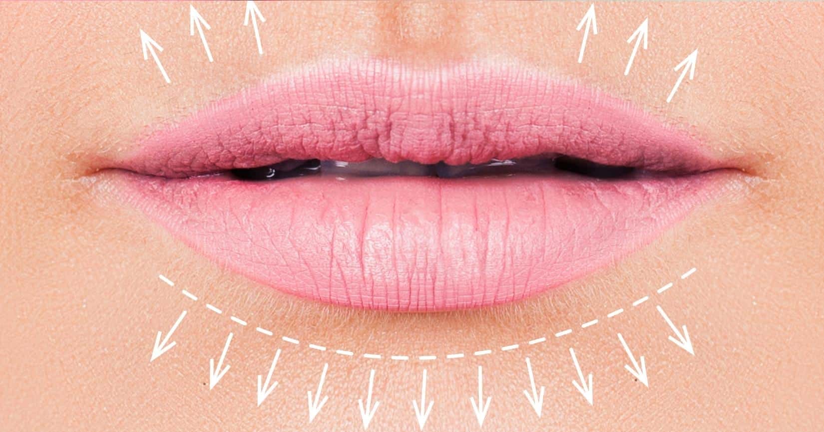 Leer más sobre el artículo Preenchimento ou Botox Labial em Fortaleza: Qual escolher?