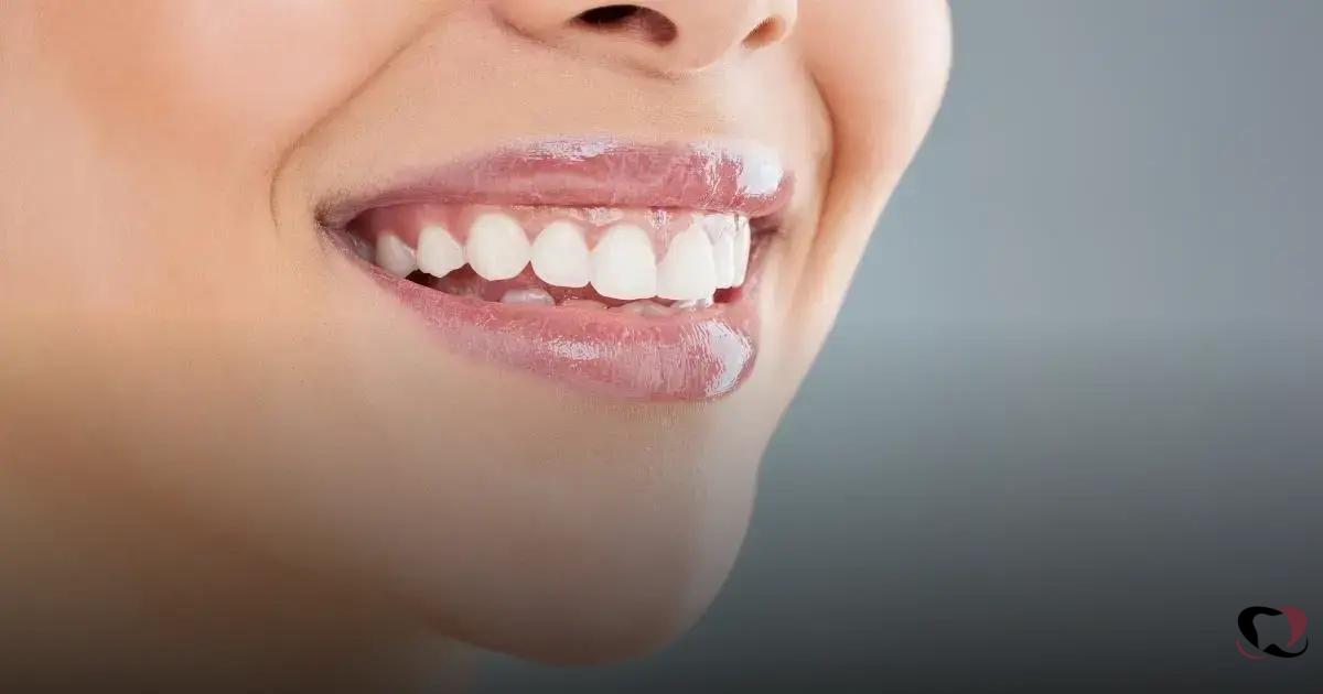 Mitos Comuns sobre Tratamento com Invisalign