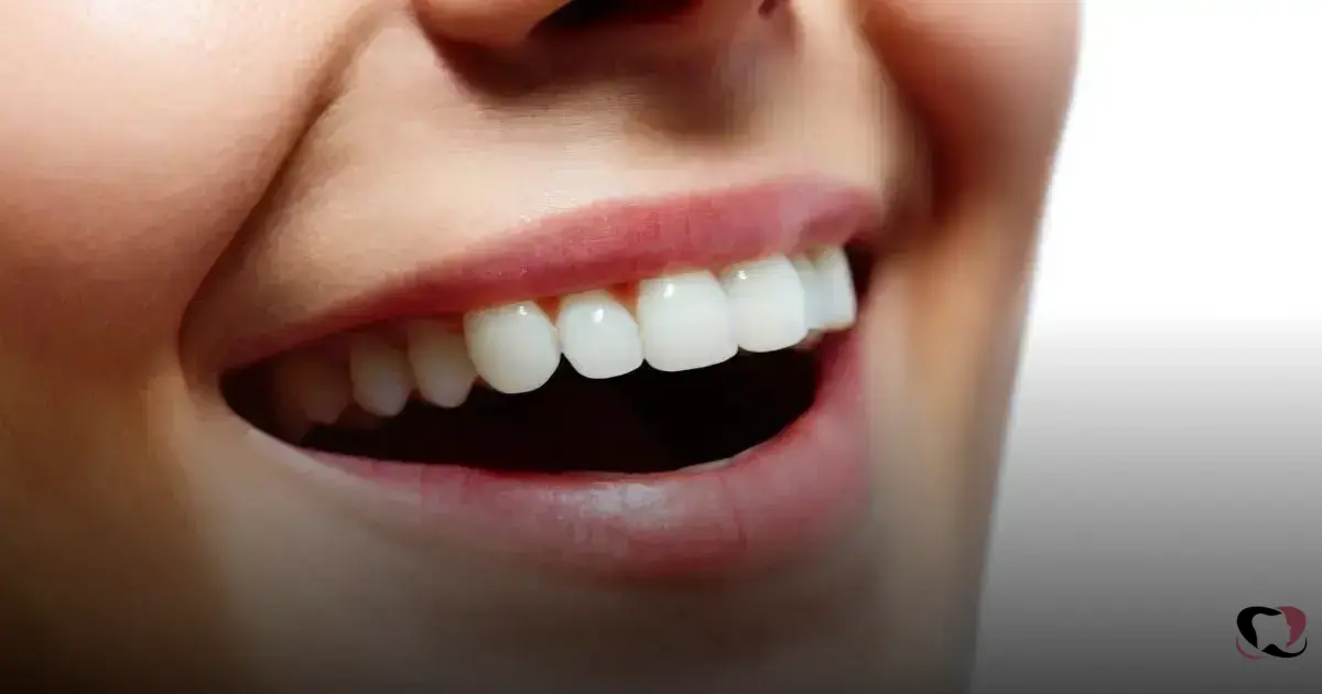 Read more about the article Aparelho Dental em Fortaleza: Soluções Modernas para seu Sorriso
