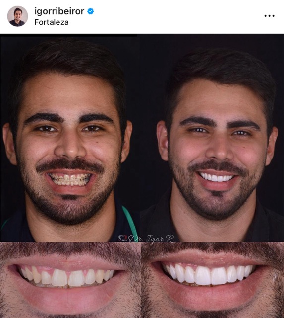 Lentes de contacto dentales en Fortaleza Dr. Igor Ribeiro lentes de porcelana Dentista Ceará