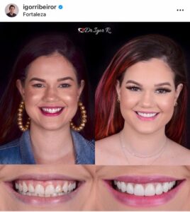 Youtuber Marina Benevides Dental contact lenses in porcelain veneer fortress