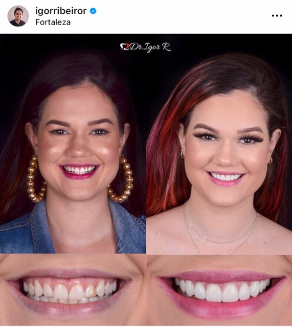 Youtuber Marina Benevides Lentes de contacto dentales en chapa de porcelana fortaleza