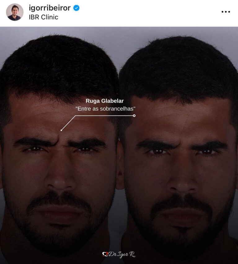 botox para rugas de bravo em fortaleza harmonização facial
