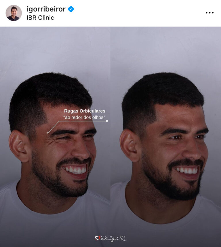 Botox em Fortaleza — IBR Clinic | Dr. Igor Ribeiro