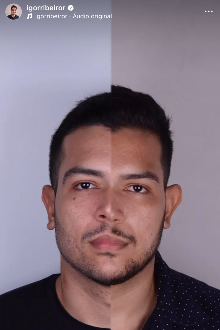 Preenchimento mandibular em Fortaleza