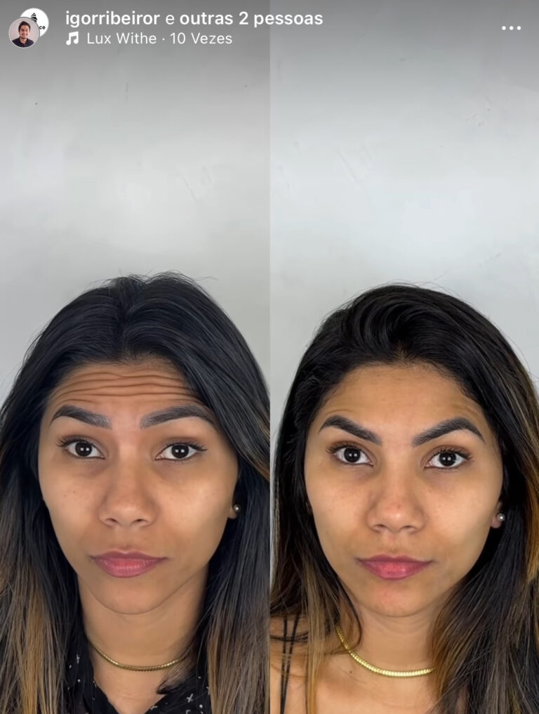 Botox em Fortaleza toxina botulinica para rugas na testa harmonização facial em fortaleza clinica estetica