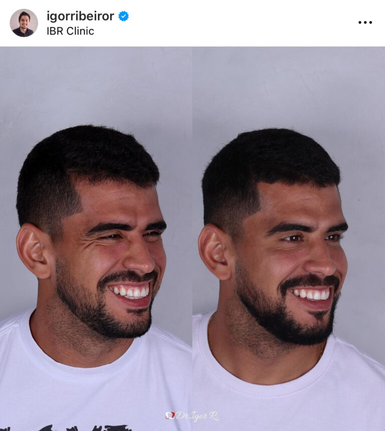Botox em Fortaleza — IBR Clinic | Dr. Igor Ribeiro