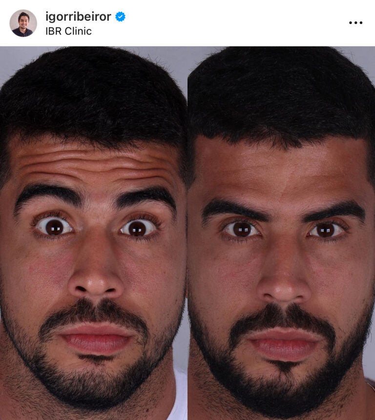 Botox na testa igor ribeiro dentista harmonizaçao facial