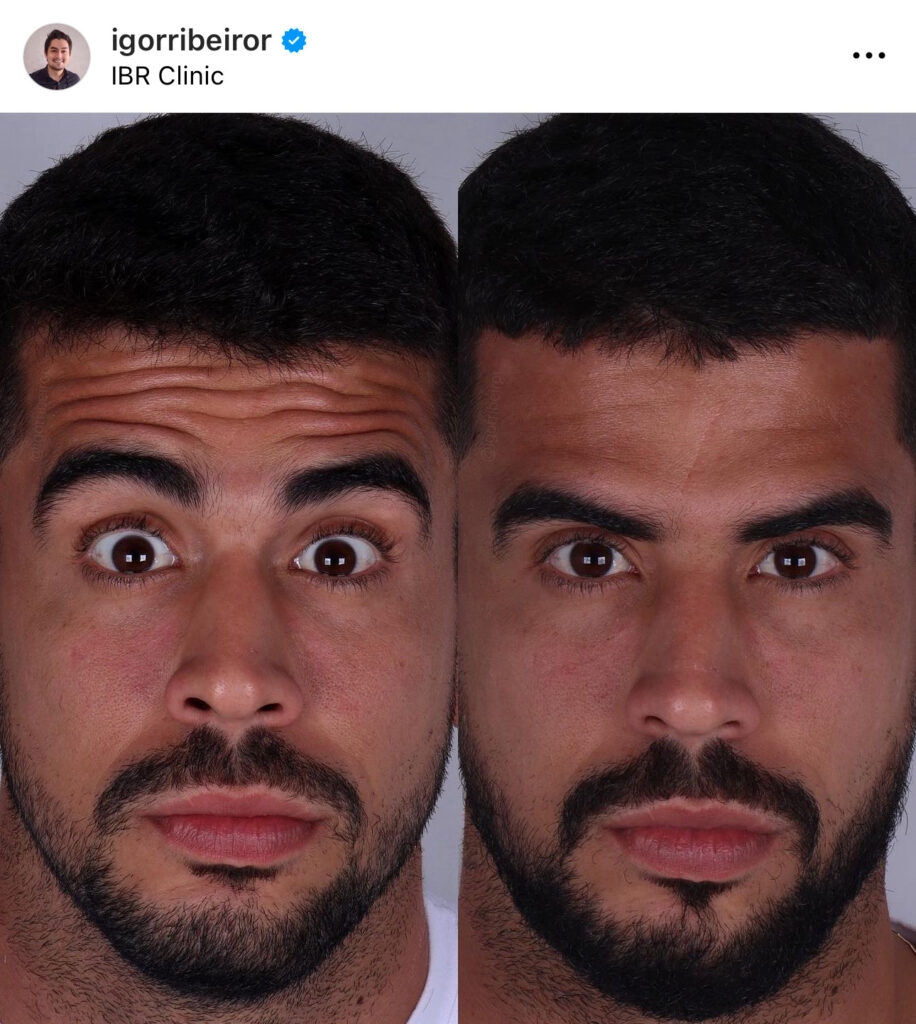 Dentista Igor Ribeiro revela segredo da Harmonização Facial nas estrelas do cinema 7 Botox na testa igor ribeiro dentista harmonizaçao facial