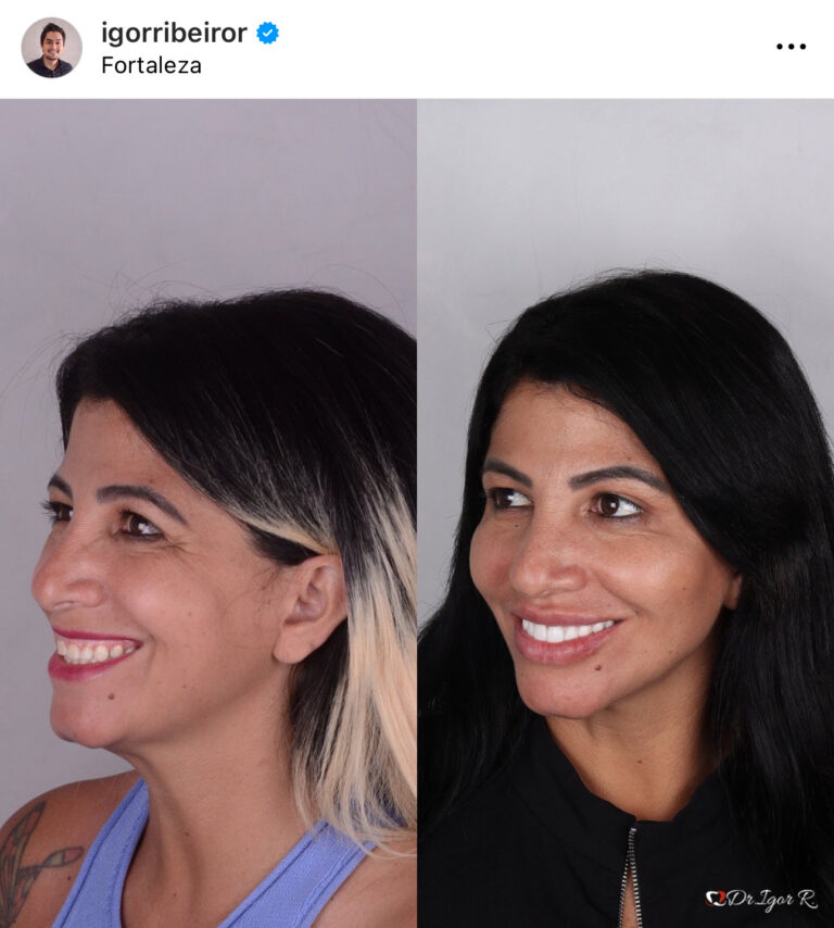 Preenchimento labial em fortaleza botox lentes de contato dental