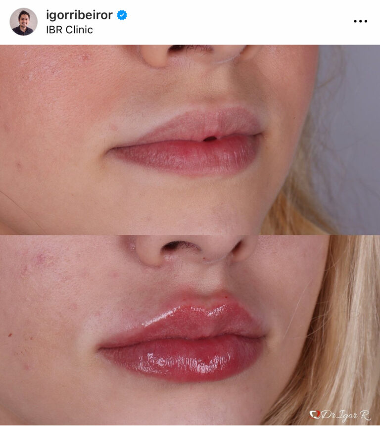 Preenchimento labial em Fortaleza — IBR Clinic | Dr. Igor Ribeiro