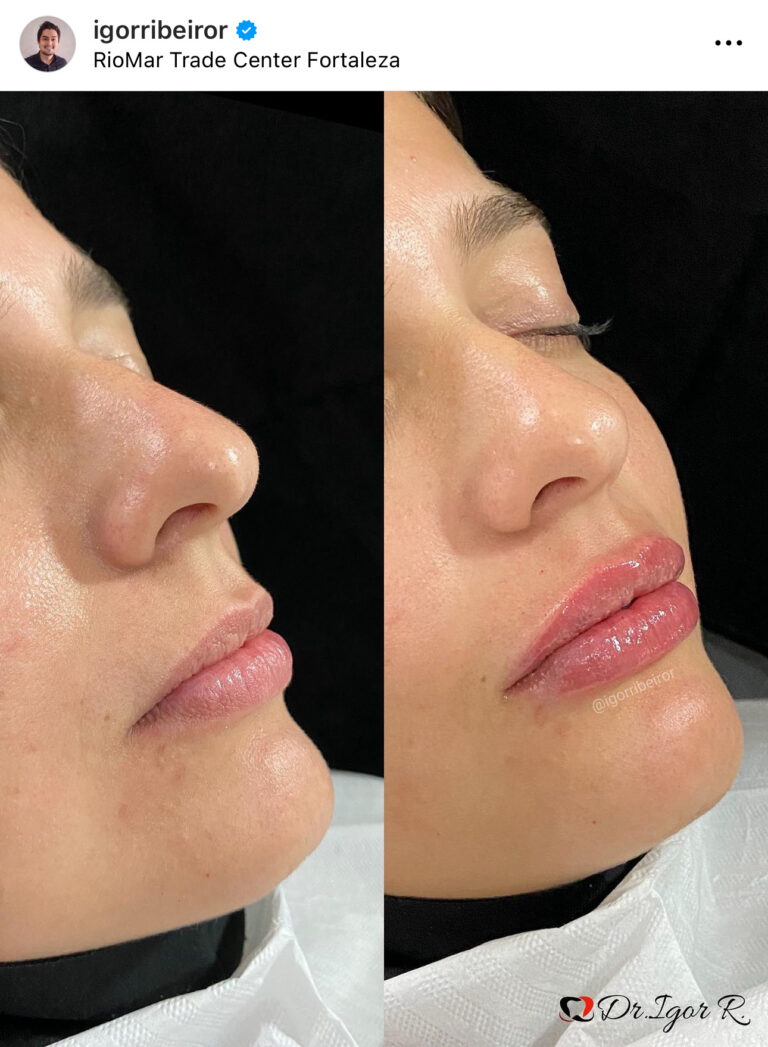 preenchimento labial em fortaleza