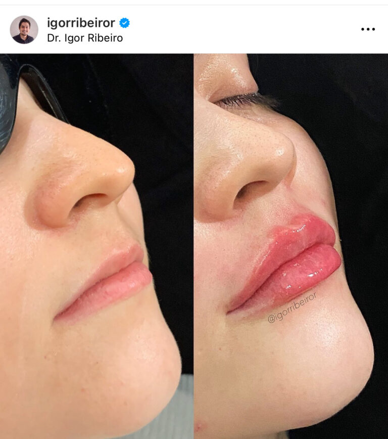 Preenchimento labial em Fortaleza — IBR Clinic | Dr. Igor Ribeiro
