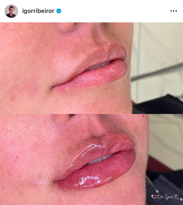 Preenchimento labial em Fortaleza — IBR Clinic | Dr. Igor Ribeiro