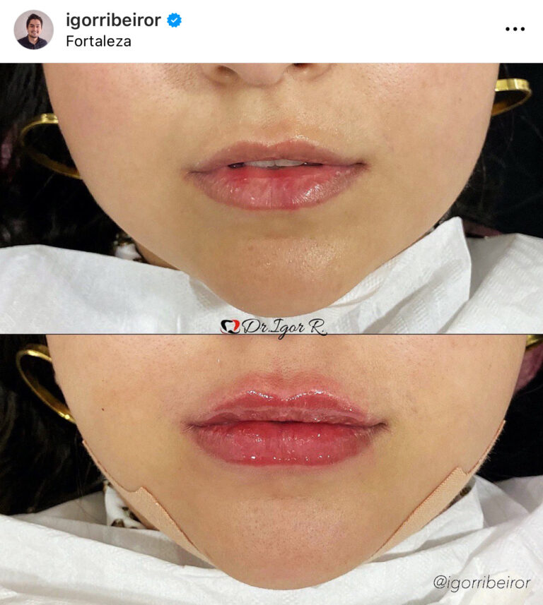 Preenchimento labial em Fortaleza — IBR Clinic | Dr. Igor Ribeiro