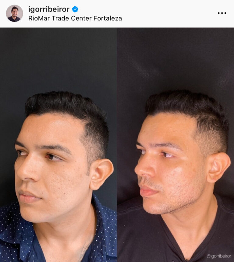 Preenchimento de mandíbula em Fortaleza — IBR Clinic | Dr. Igor Ribeiro
