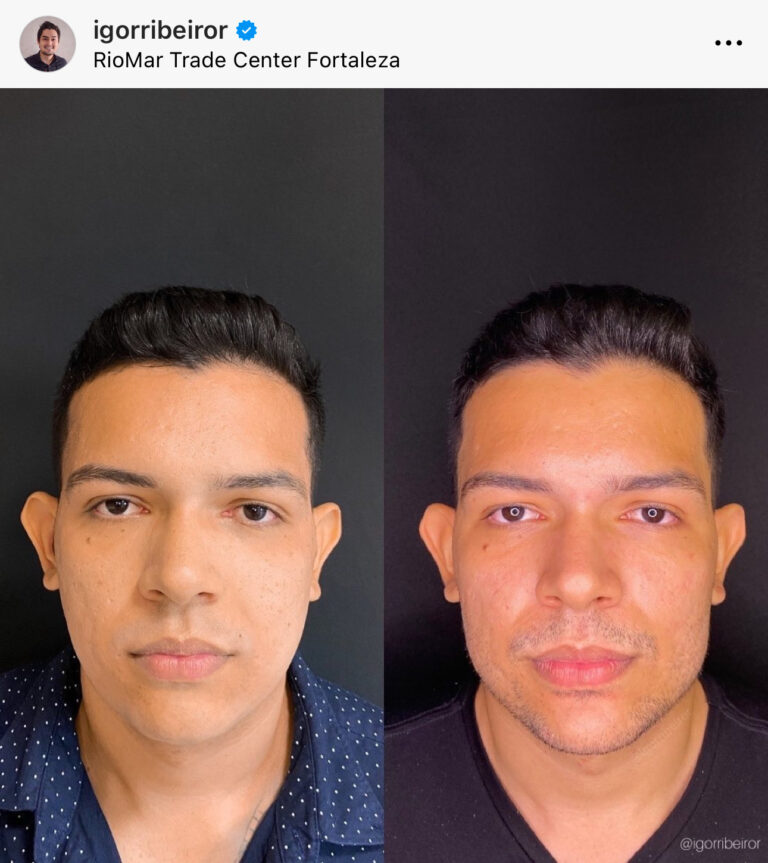 Preenchimento de mandíbula em Fortaleza — IBR Clinic | Dr. Igor Ribeiro