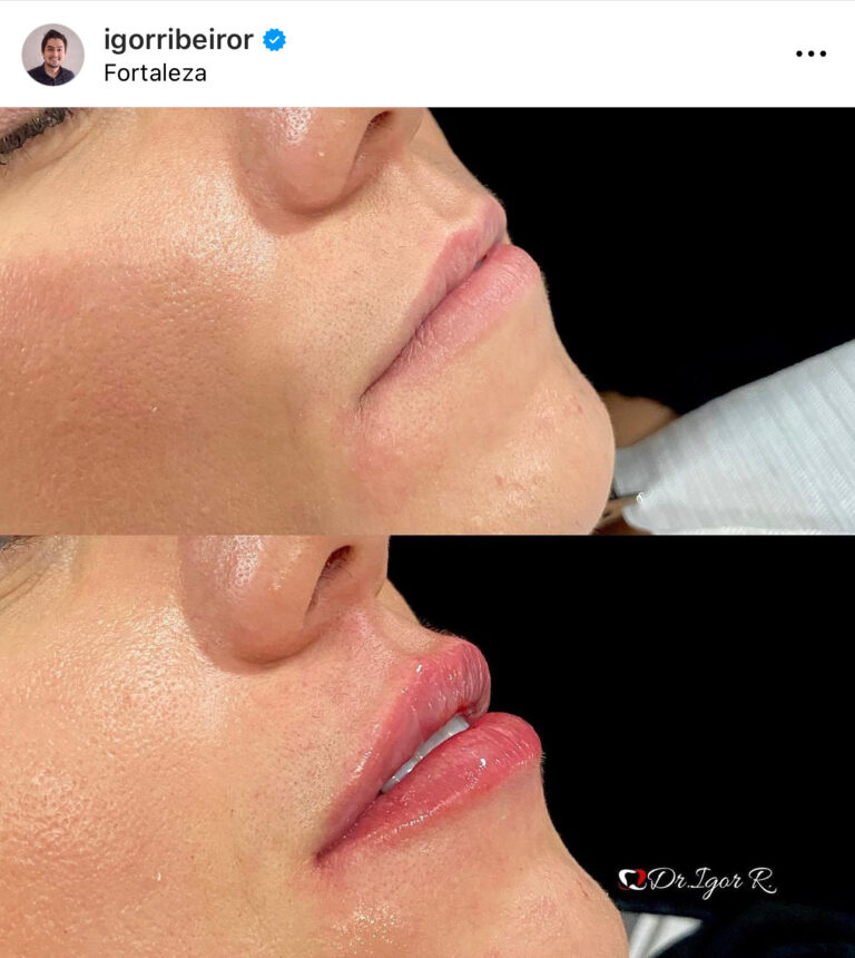 preenchimento labial em fortaleza