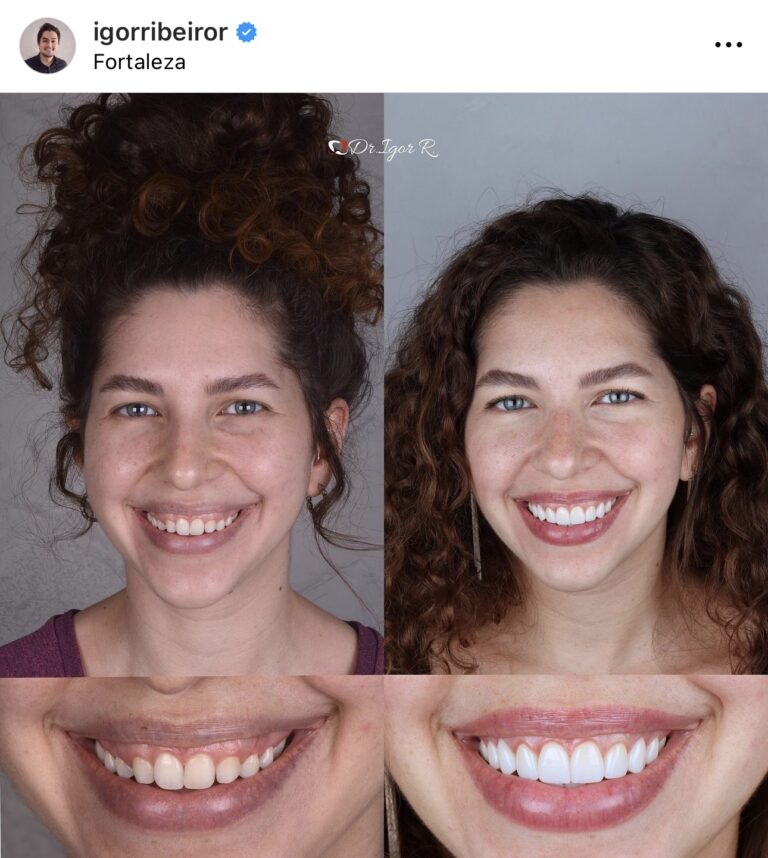 Paciente mulher lente de contato dental sorriso perfeito com lentes