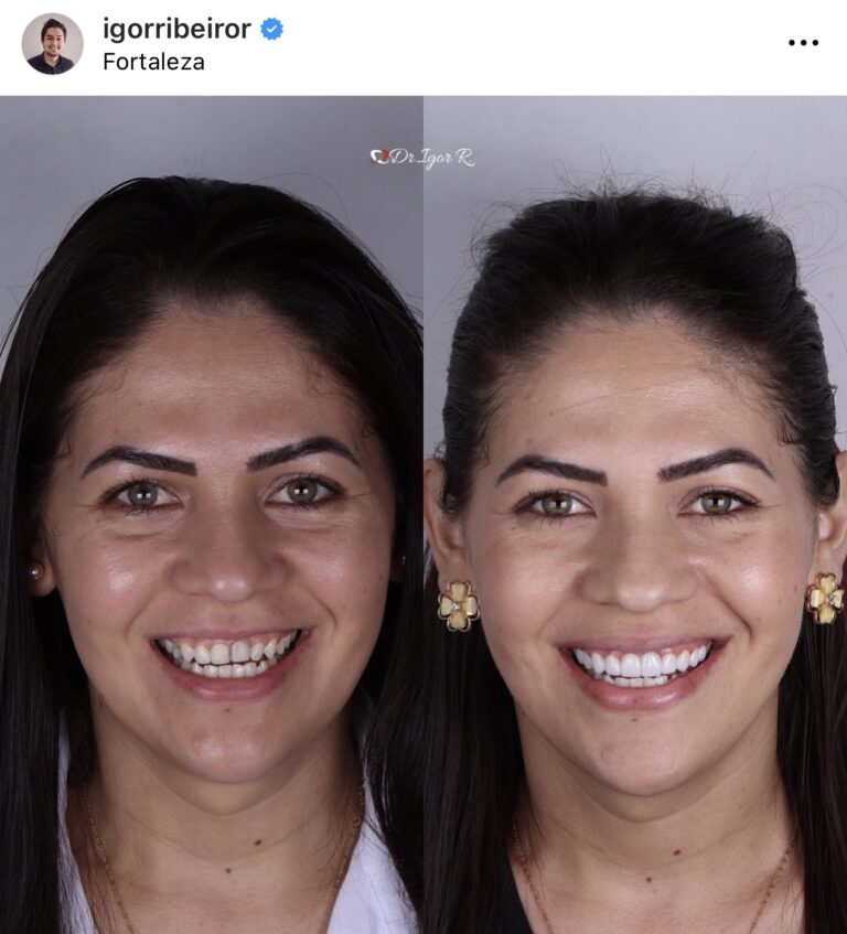 Paciente de Portugal IBR Clinica Dentista Fortaleza Lente de contato dental