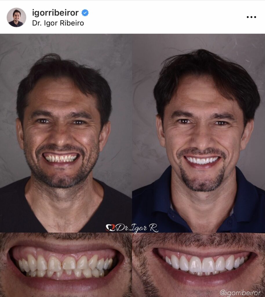 Dental bruxism patient improves smile with dental contact lens