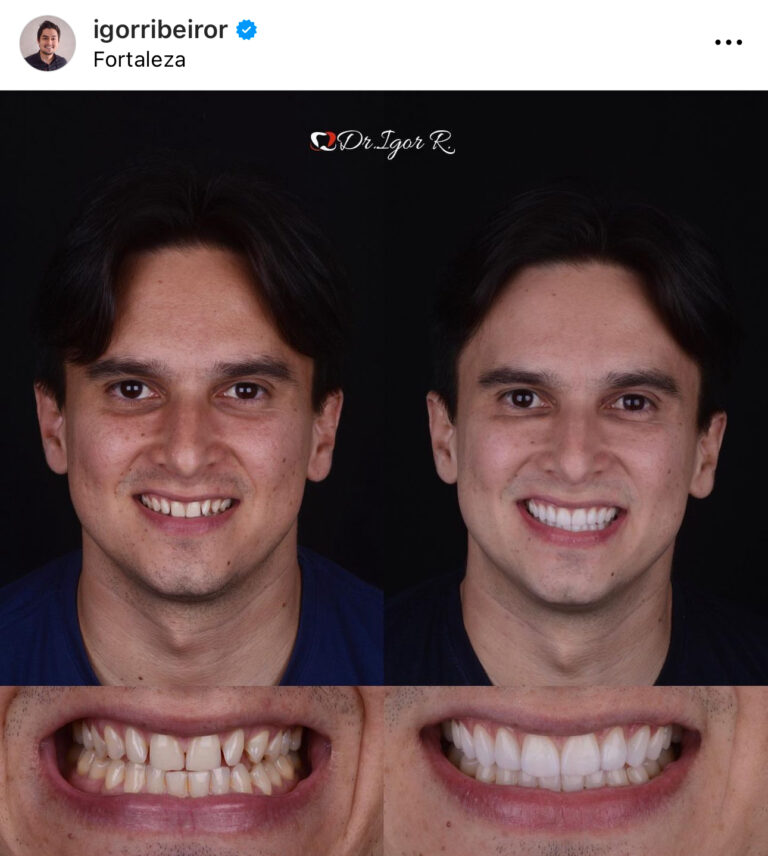 Paciente dentes conoides lentes de contato dentista em fortaleza porcelana