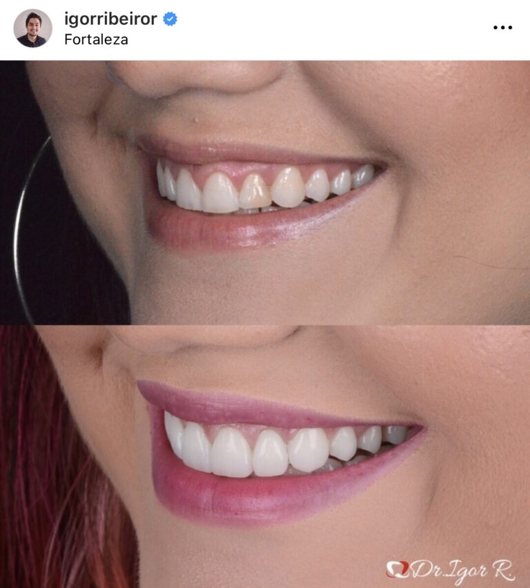 Youtuber Marina Benevides lente de contato dental em fortaleza