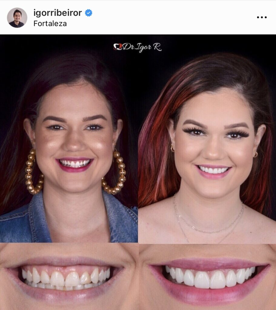 Youtuber Marina Benevides dental contact lens in Fortaleza