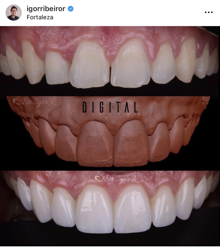 Digital smile dental contact lenses in Fortaleza
