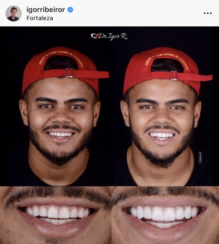 Jogador João Paulo São Paulo lente de contato dental em fortaleza Dr. Igor Ribeiro