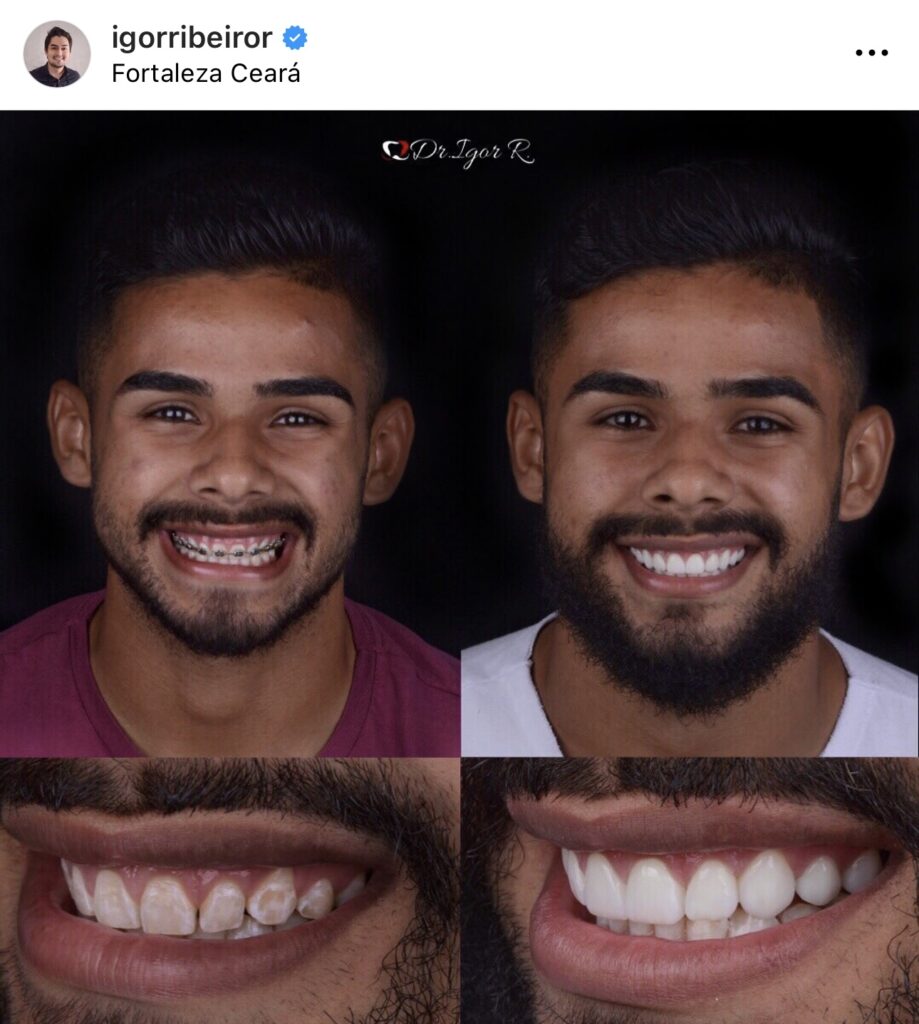 Transformación de Sonrisa con 10 Lentes de Contacto Dentales - Jugador Felipe Jonatan - Fortaleza 2 Transformación de Sonrisa con lentes dentales Jugador Felipe Jonatan Fortaleza