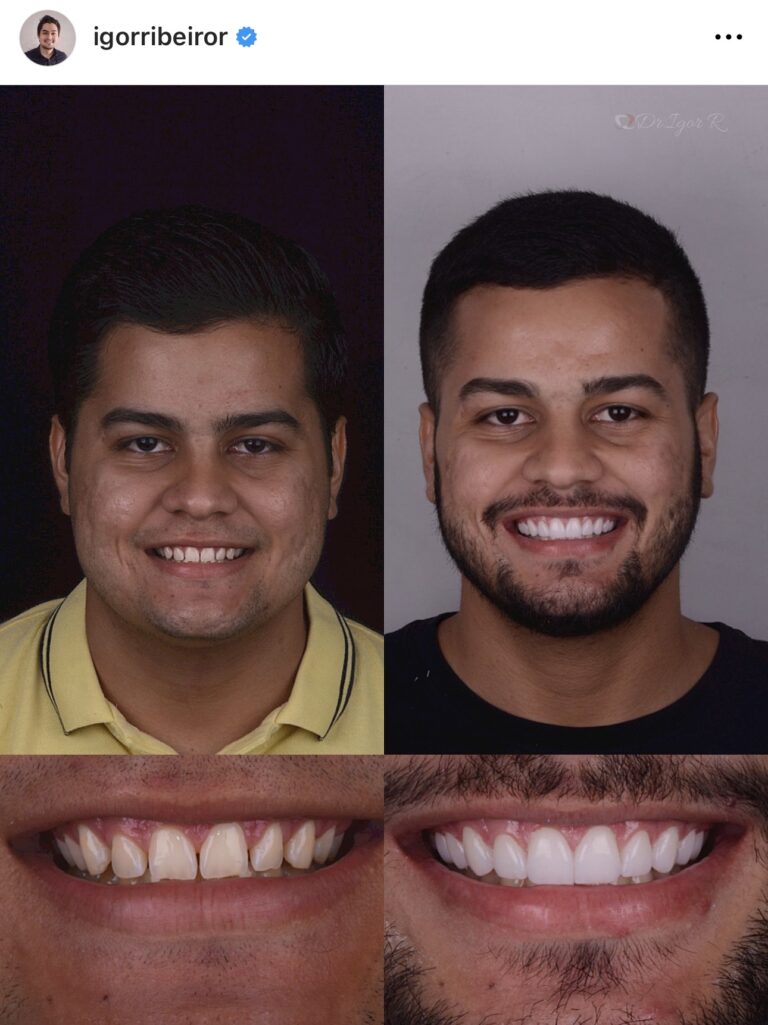 Lente de contato dental na cidade de fortaleza dr igor ribeiro @igorribeiror