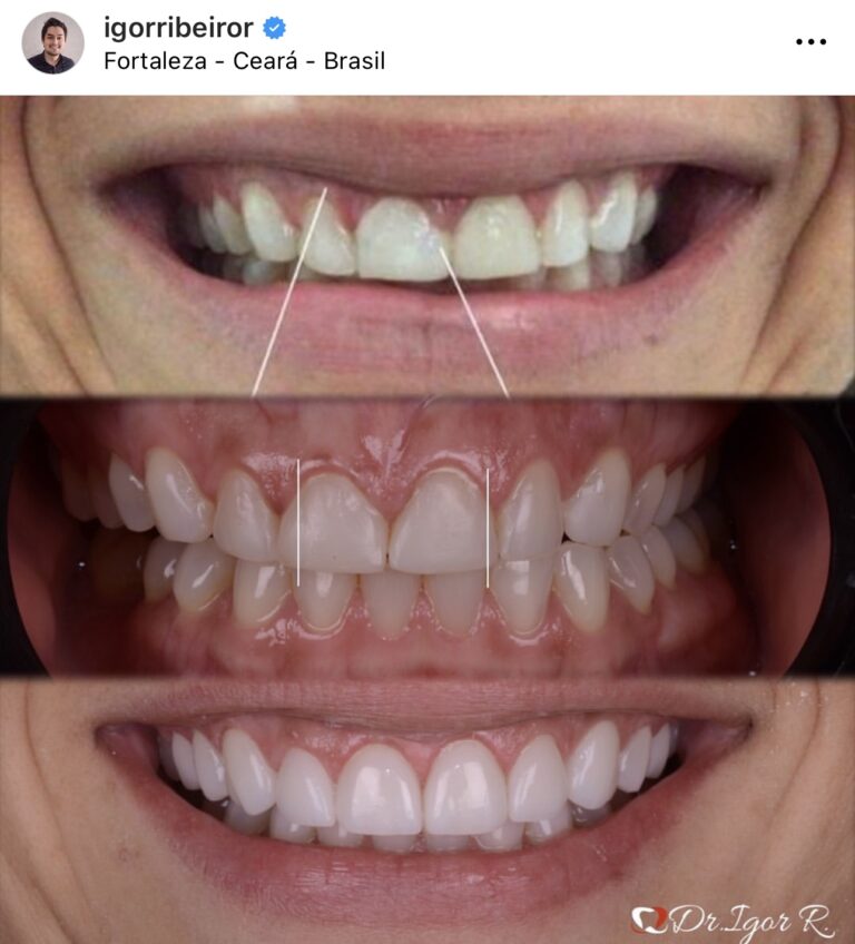 Gengivoplastia e Facetas em Porcelana Ceara Fortaleza
