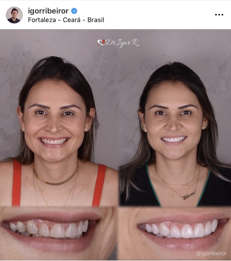 Transformação do sorriso com lentes de contato dental em fortaleza