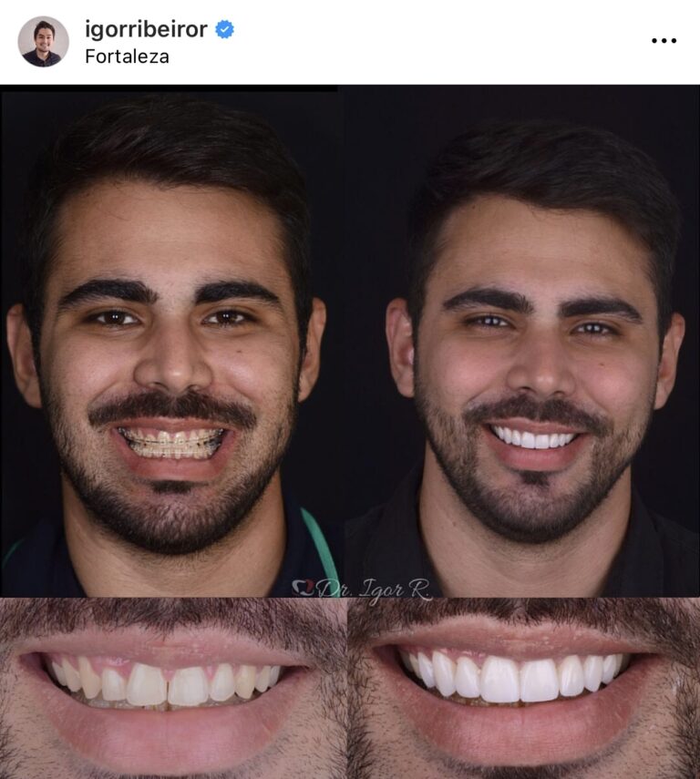 Lente Dental em Fortaleza aparelho ortodôntico