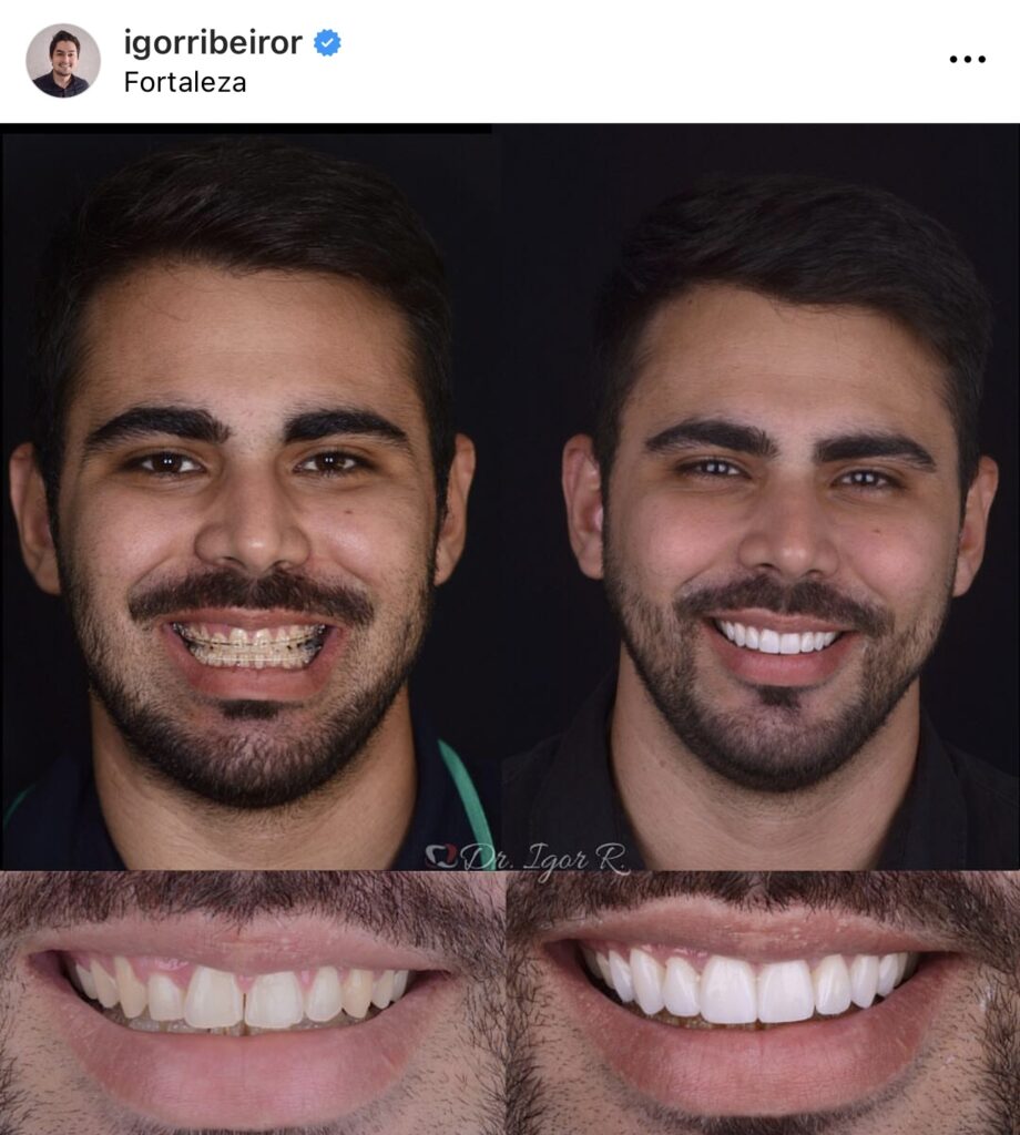 Dental Lens in Fortaleza orthodontic device