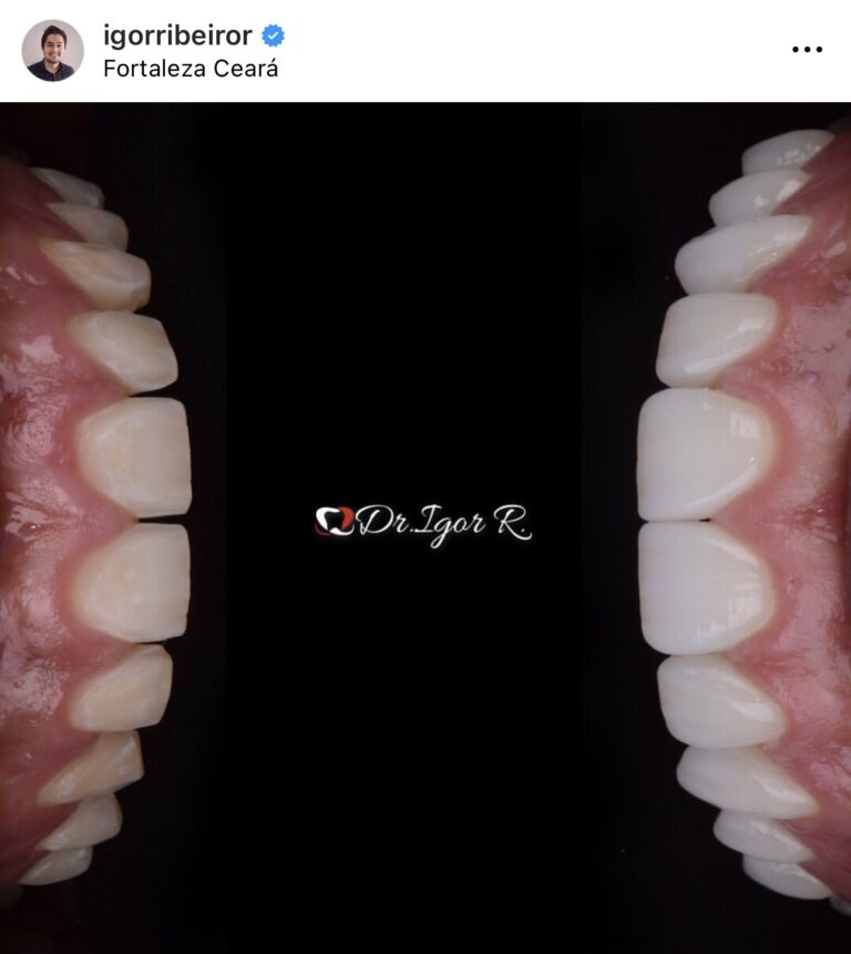 Lente dental facetas de porcelana Felipe Jr Jogador Fortaleza Santos Dentista Dr. Igor Ribeiro