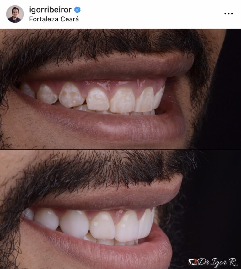 Lente Dental em Fortaleza Sorriso Felipe Johnnatan Santos