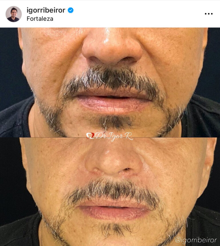 preenchimento de bigode chines em fortaleza