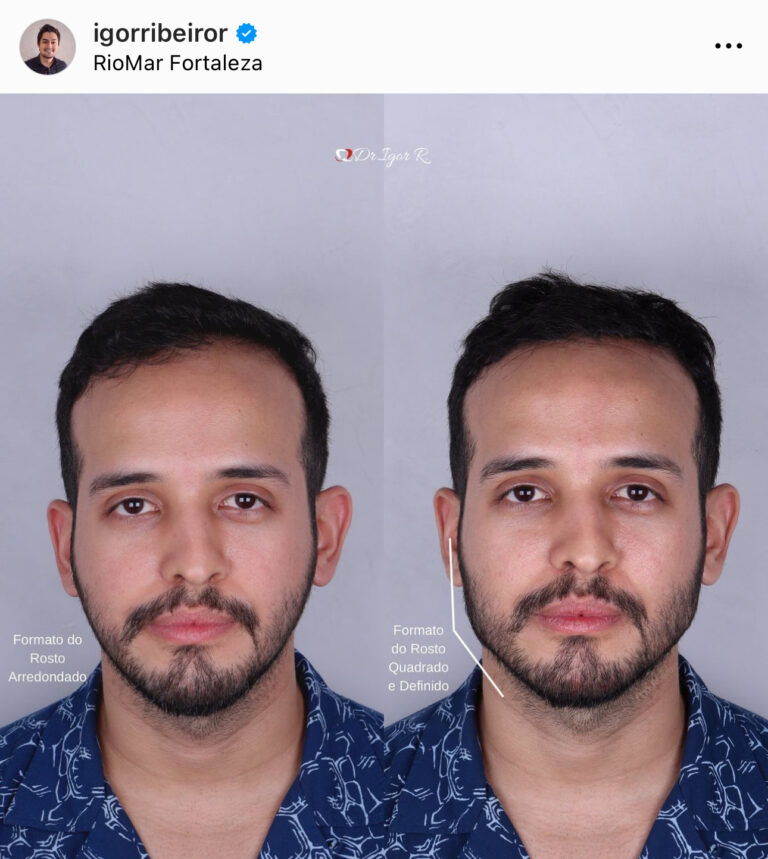 Preenchimento mandibular em fortaleza clinica estética mandibula