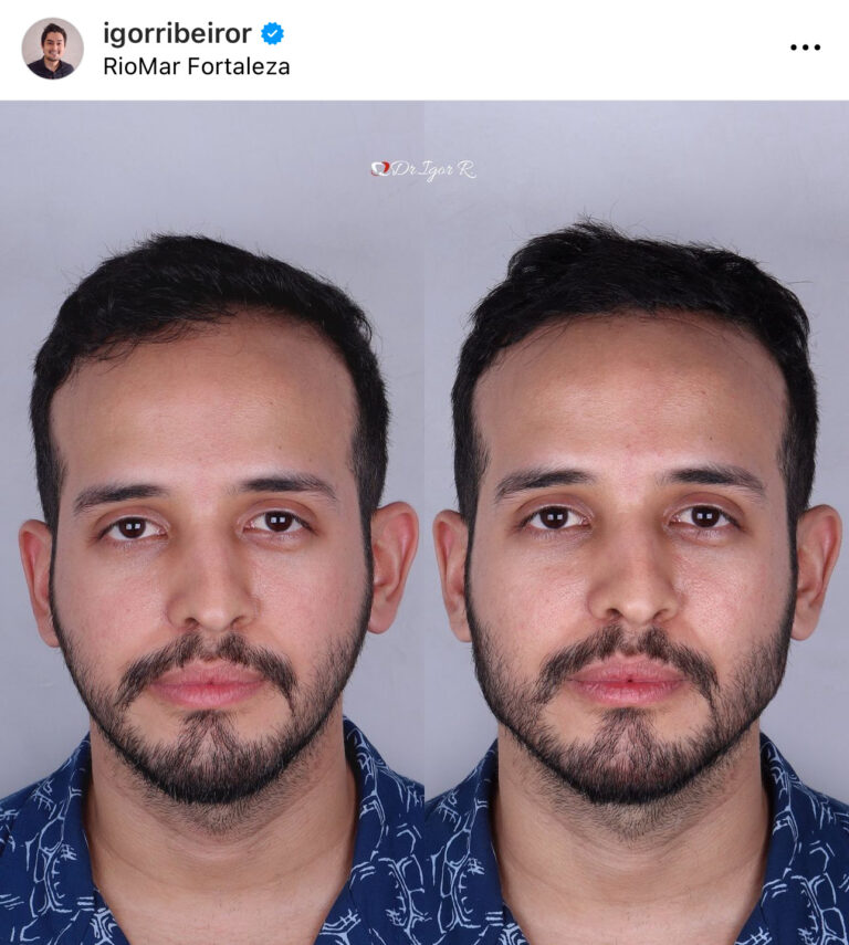 Preenchimento de mandíbula em Fortaleza — IBR Clinic | Dr. Igor Ribeiro