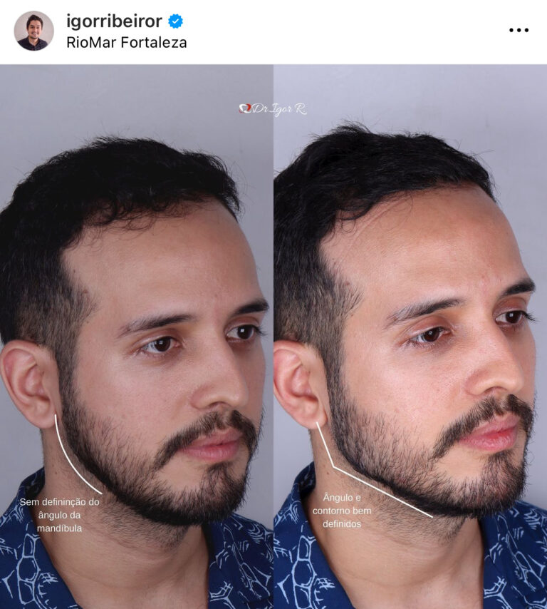 preenchimento da mandibula em fortaleza contorno maxilar mandibula mais defininda rosto quadrado fortaleza
