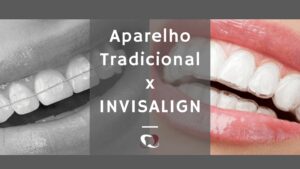 Scopri di più sull'articolo Invisalign em Fortaleza: O Segredo dos Atletas para um Sorriso Perfeito