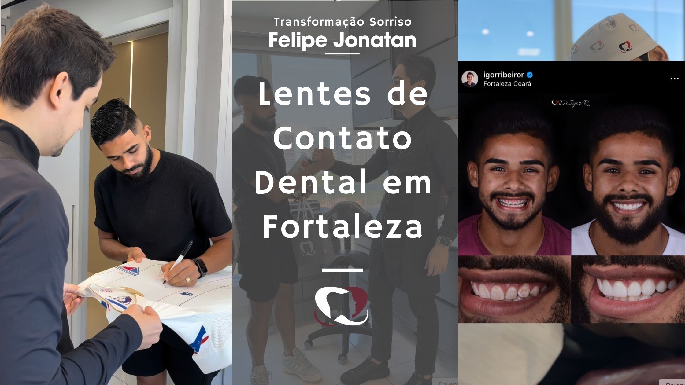 Leer más sobre el artículo Transformação de Sorriso com Lentes Dentais: Felipe Jonatan do Fortaleza EC | Dr. Igor Ribeiro