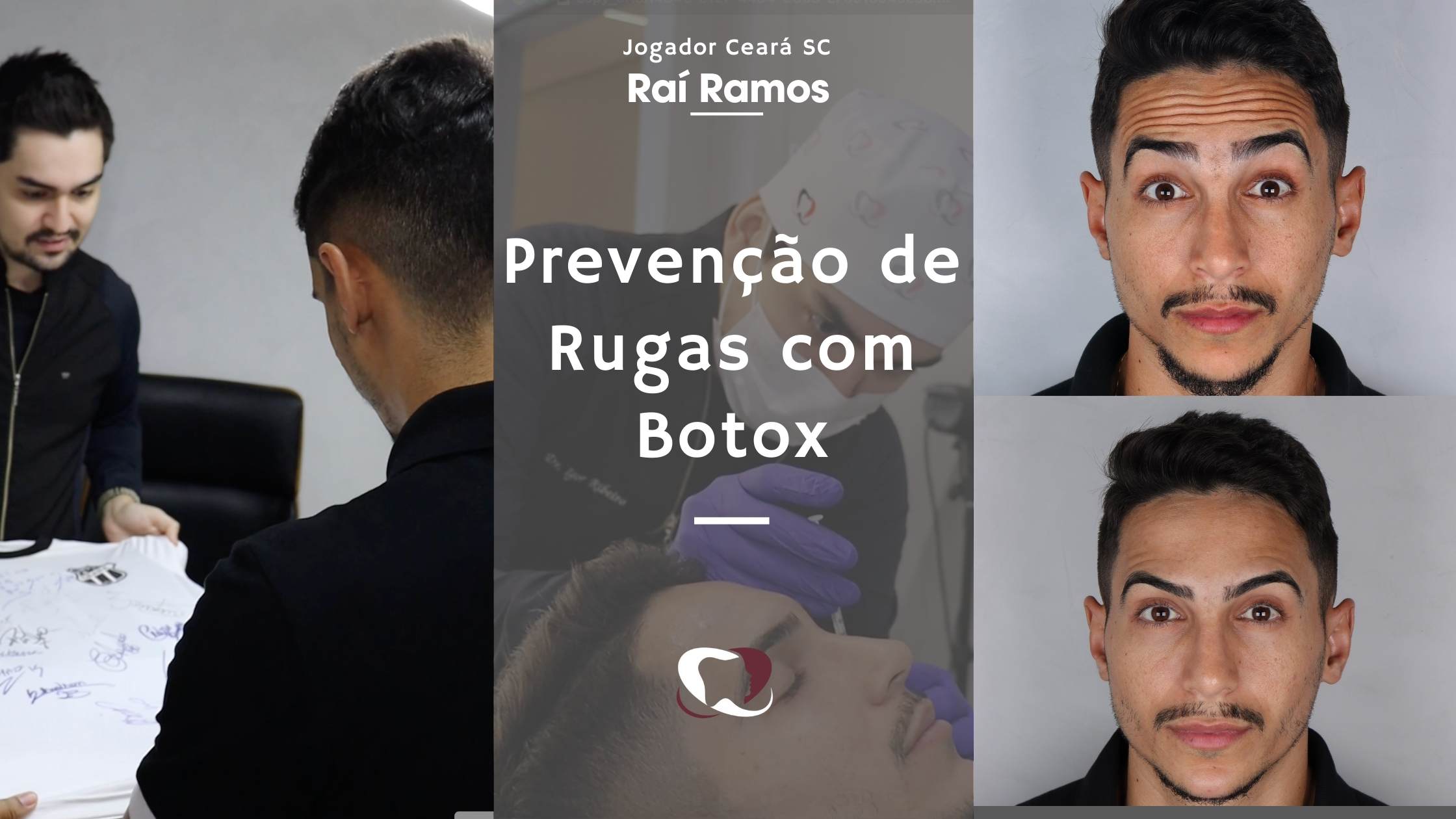 Leer más sobre el artículo Botox preventivo em Atletas: Caso Raí Ramos na IBR Clinic em Fortaleza