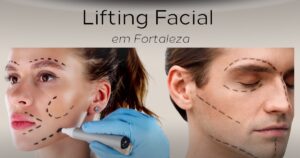 Read more about the article Lifting facial em Fortaleza: descubra os segredos para rejuvenescer sua aparência agora