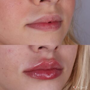 Leia mais sobre o artigo Preenchimento Labial em Fortaleza: Fotos [Antes/Depois] e Durabilidade