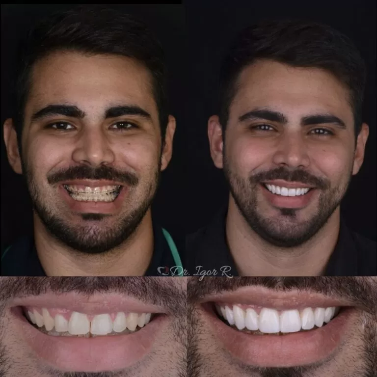 Antes e Depois Lente de contato dental em Fortaleza Dr. Igor Ribeiro | Igor Ribeiro