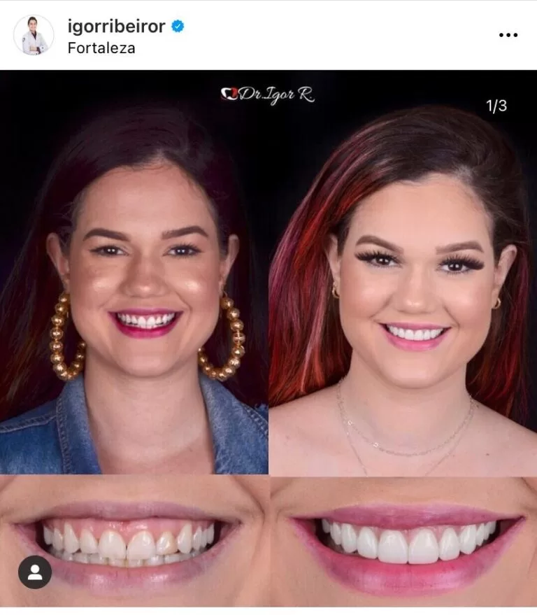 Home 22 Antes e depois de lentes dentais IPS e.max — correção de Resinas antigas pelo Dr. Igor Ribeiro, Fortaleza-CE